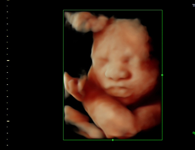 3D ultrasound image at 29 weeks
